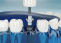 Top 3 Reasons You Should Choose Dental Implants Over Other Alternatives