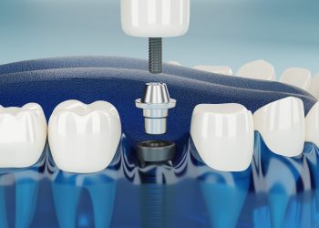 Top 3 Reasons You Should Choose Dental Implants Over Other Alternatives