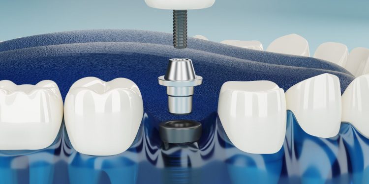 Top 3 Reasons You Should Choose Dental Implants Over Other Alternatives