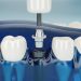 Top 3 Reasons You Should Choose Dental Implants Over Other Alternatives