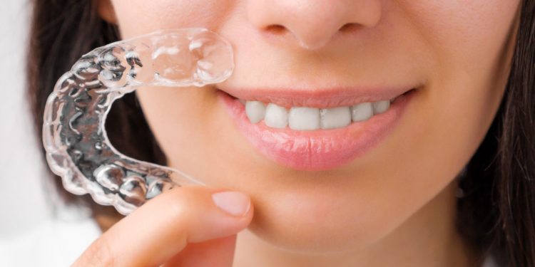 ParisAline Clear Aligners: Embracing the Smile of the Future
