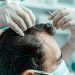 Understanding Your Hair Surgery Journey at Concord Hair Restoration, Los Angeles