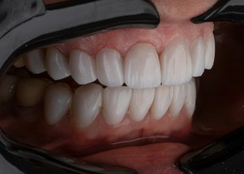 The Future of Dental Restoration: Exploring Same-Day Crowns
