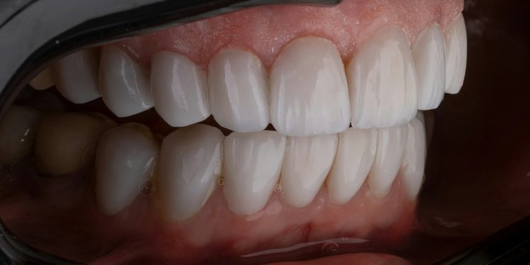 The Future of Dental Restoration: Exploring Same-Day Crowns