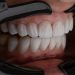 The Future of Dental Restoration: Exploring Same-Day Crowns