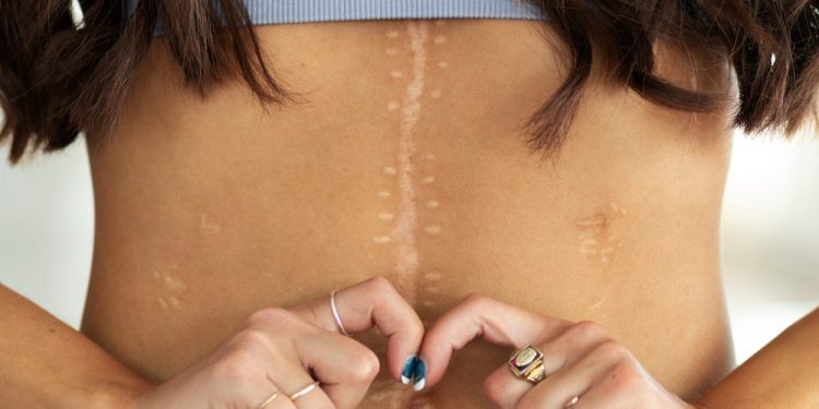 Scar Camouflage Techniques: Everything You Need to Know